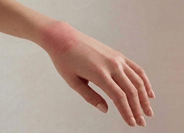 Аллергическая крапивница