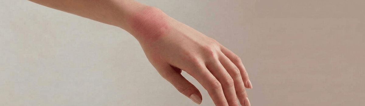 Аллергическая крапивница